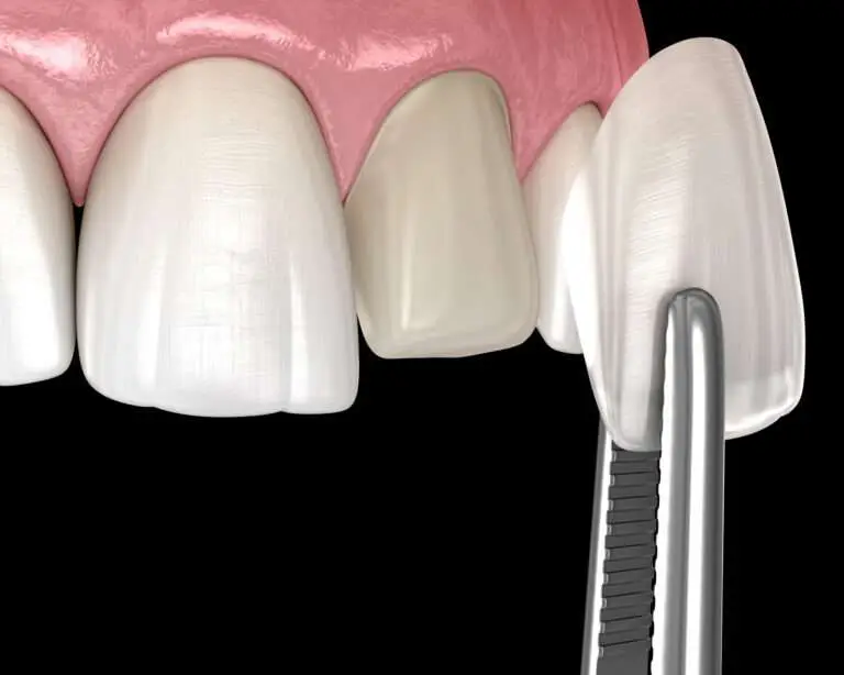 Lächelnde Frau mit makellosen Zähnen dank Veneers – ästhetische Zahnkorrektur mit Keramikverblendschalen