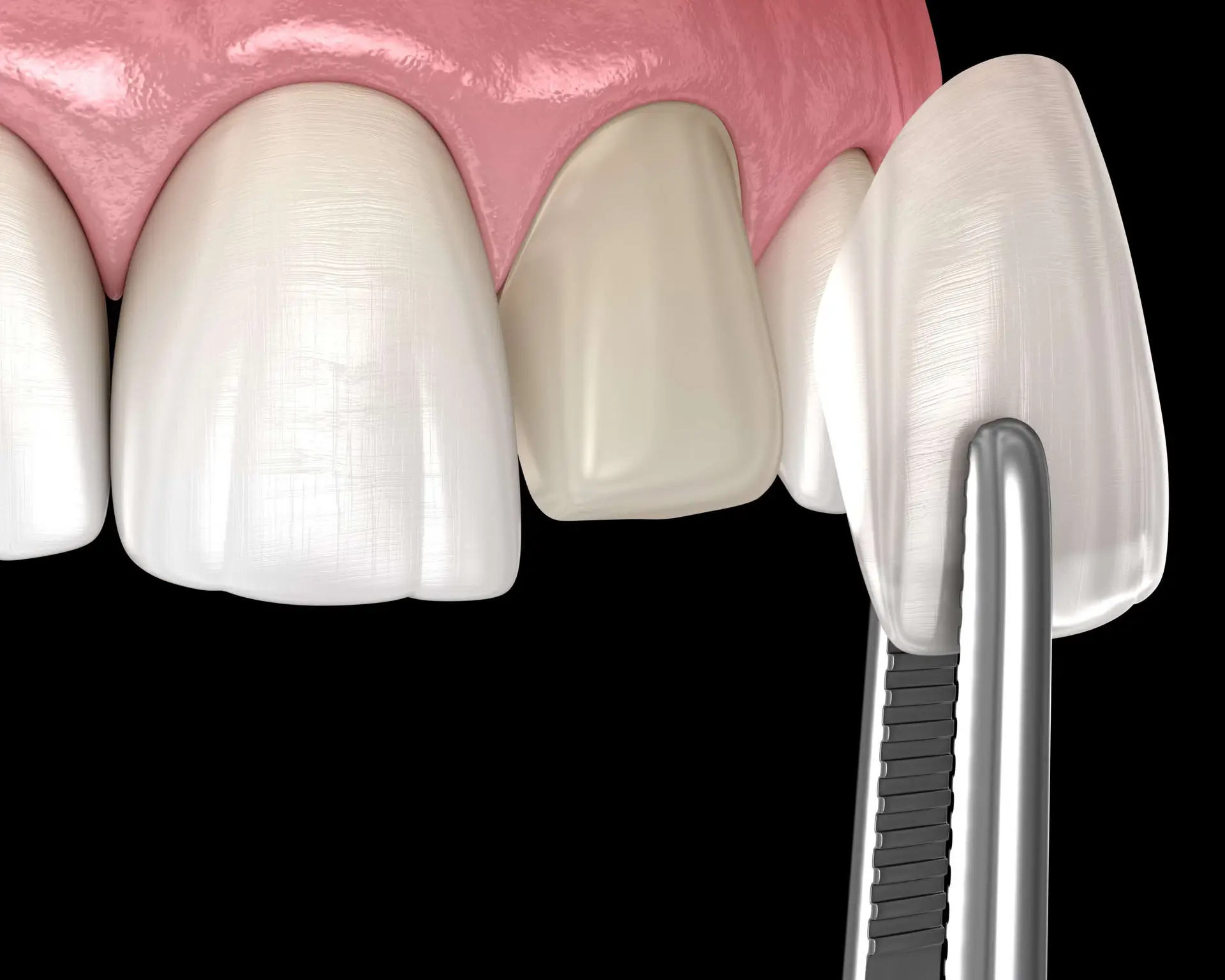 Lächelnde Frau mit makellosen Zähnen dank Veneers – ästhetische Zahnkorrektur mit Keramikverblendschalen